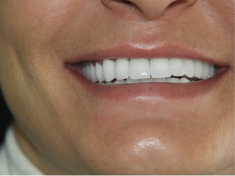 Crystal WhiteVeneerCrown Before/After Trudent