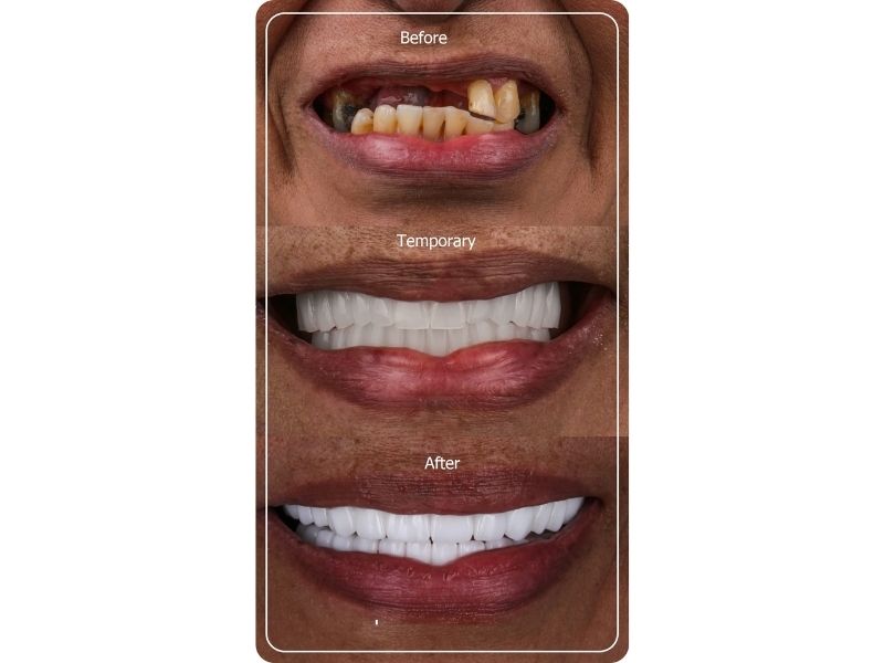 Multiple Implants+Veneer Crown Before/After Trudent