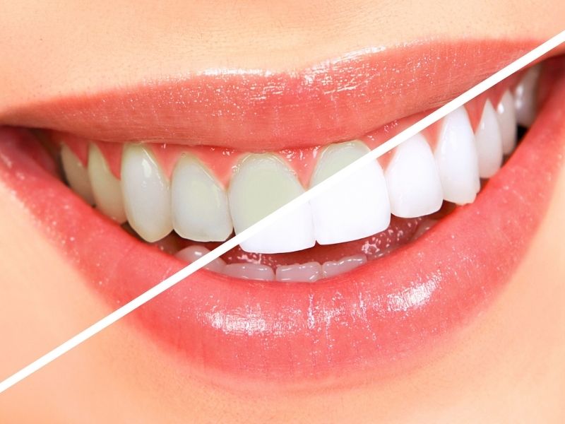 home-kit-teeth-whitening