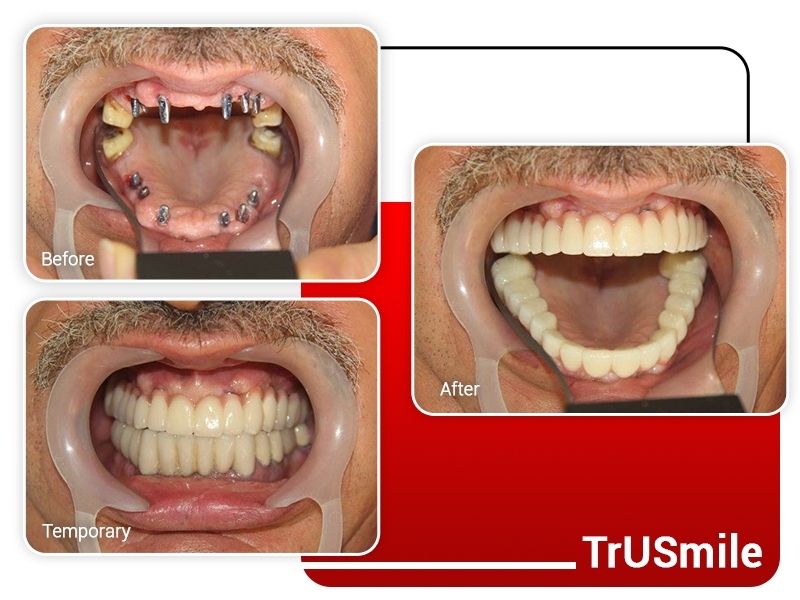 Multiple Implants+Veneer Crown Aesthetic Dentistry