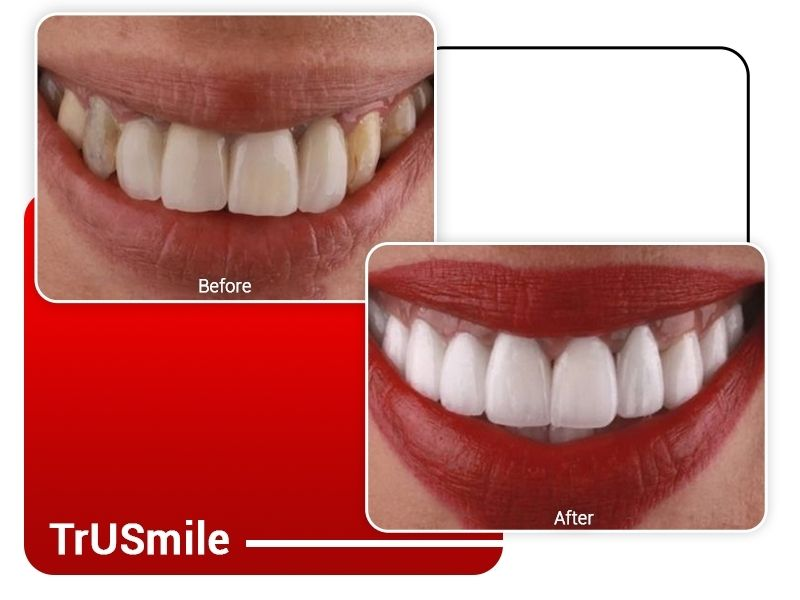 e-max-zirconia-before-after