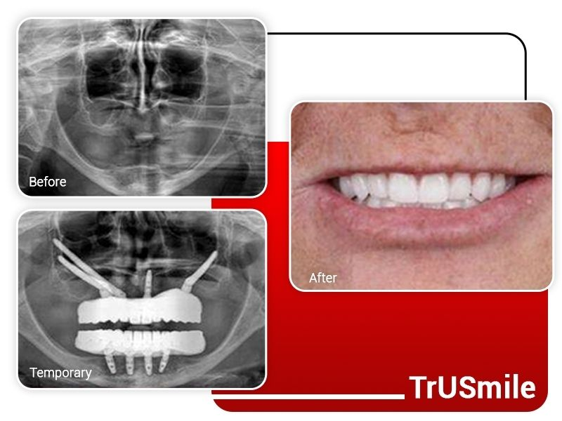 zygomatic-implant-e-max-veneer-before-after