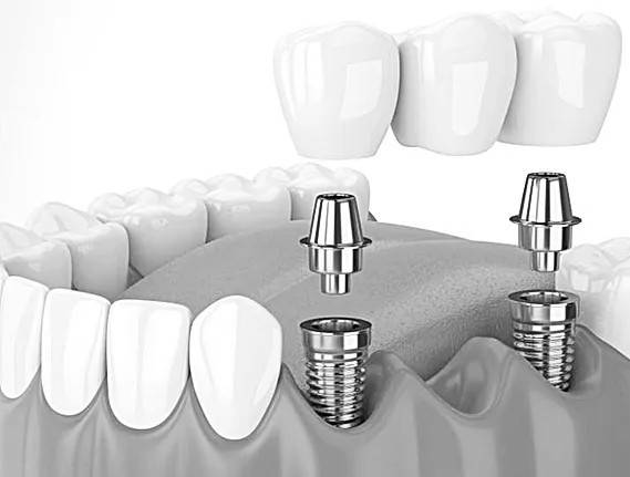 implantaten-als-vervanging-voor-meerdere-tanden