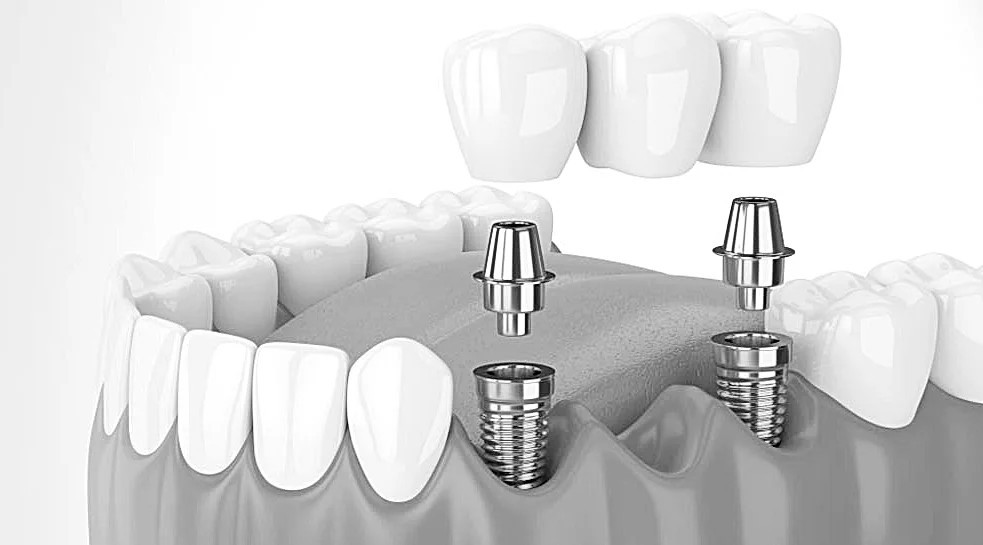 tandheelkundig-implantaat
